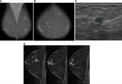 Prospective study: Impact of breast magnetic resonance imaging on oncoplastic surgery and on indications of mastectomy in patients who were previously candidates to breast conserving surgery